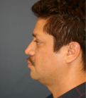 Feel Beautiful - Rhinoplasty 224 - Before Photo